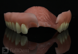 Breflex Full Dent
