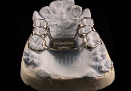 Rapid Palatal Expander orthodontics dental lab