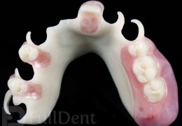 biodentaplast partial denture