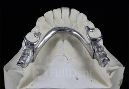 partial skeletal dentures
