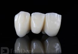 temporary crowns Full Dent lab