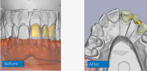 CAD CAM before and after dental lab