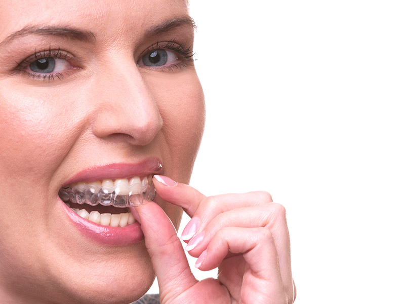 Dental Lab Clear Braces FullAlign