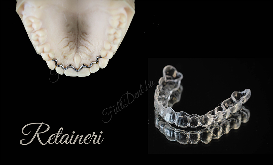 Retaineri i retencija u ortodontskoj terapiji