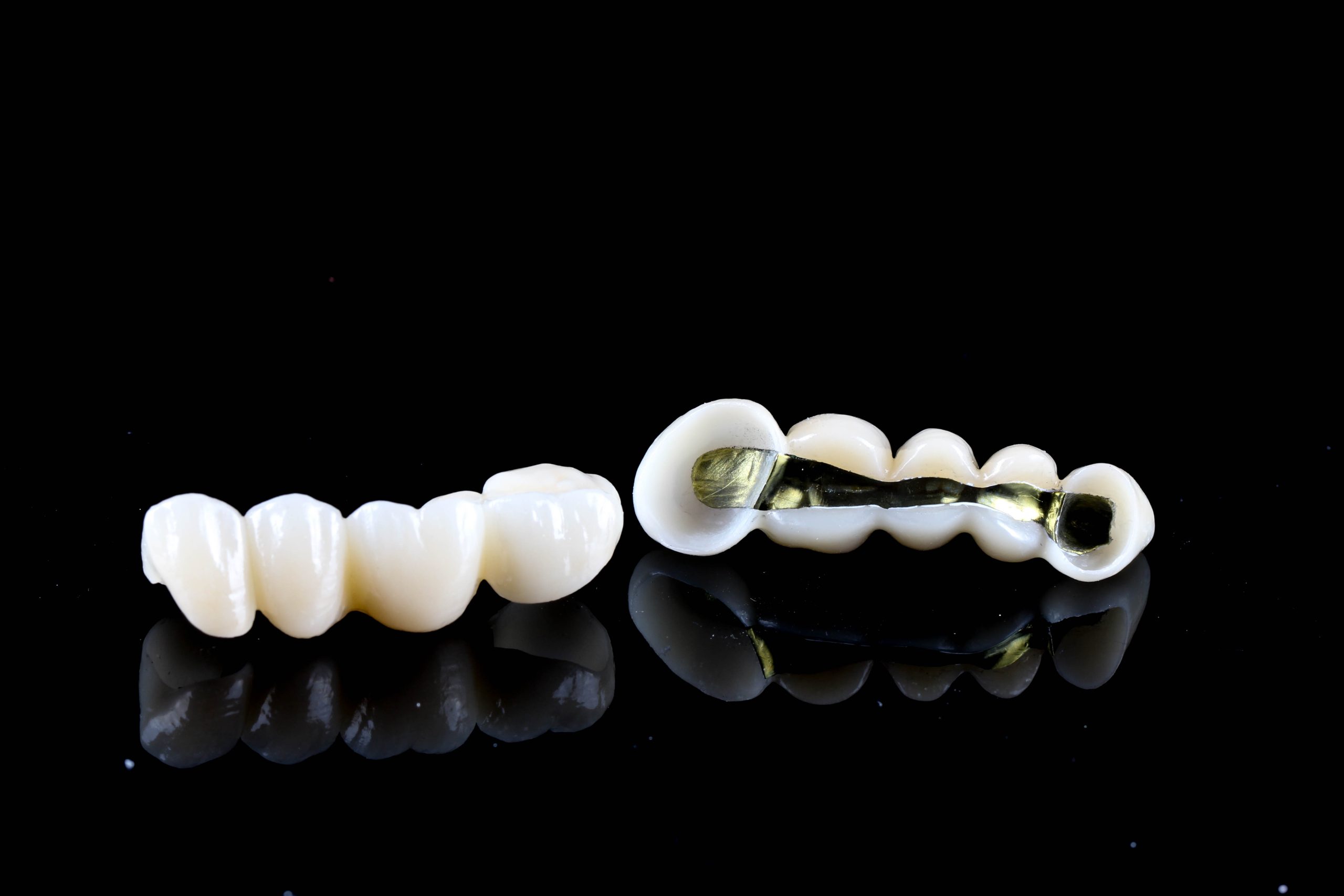 Ti prečke – idealno rješenje za pojačanje čvrstoće cirkonijumskih mostova